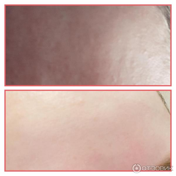 Сыворотка против акне Lefami Fem Fatal acne remover фото