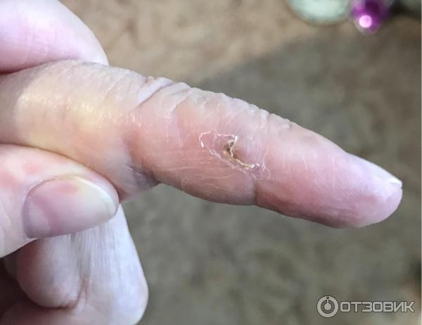 Палец после